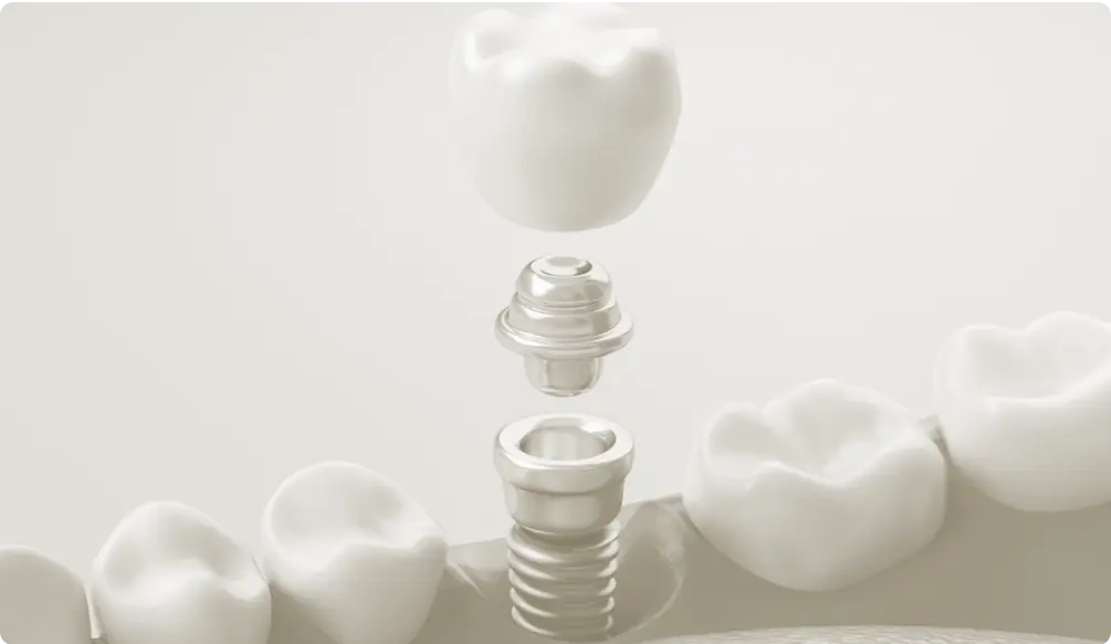 Implantes dentales