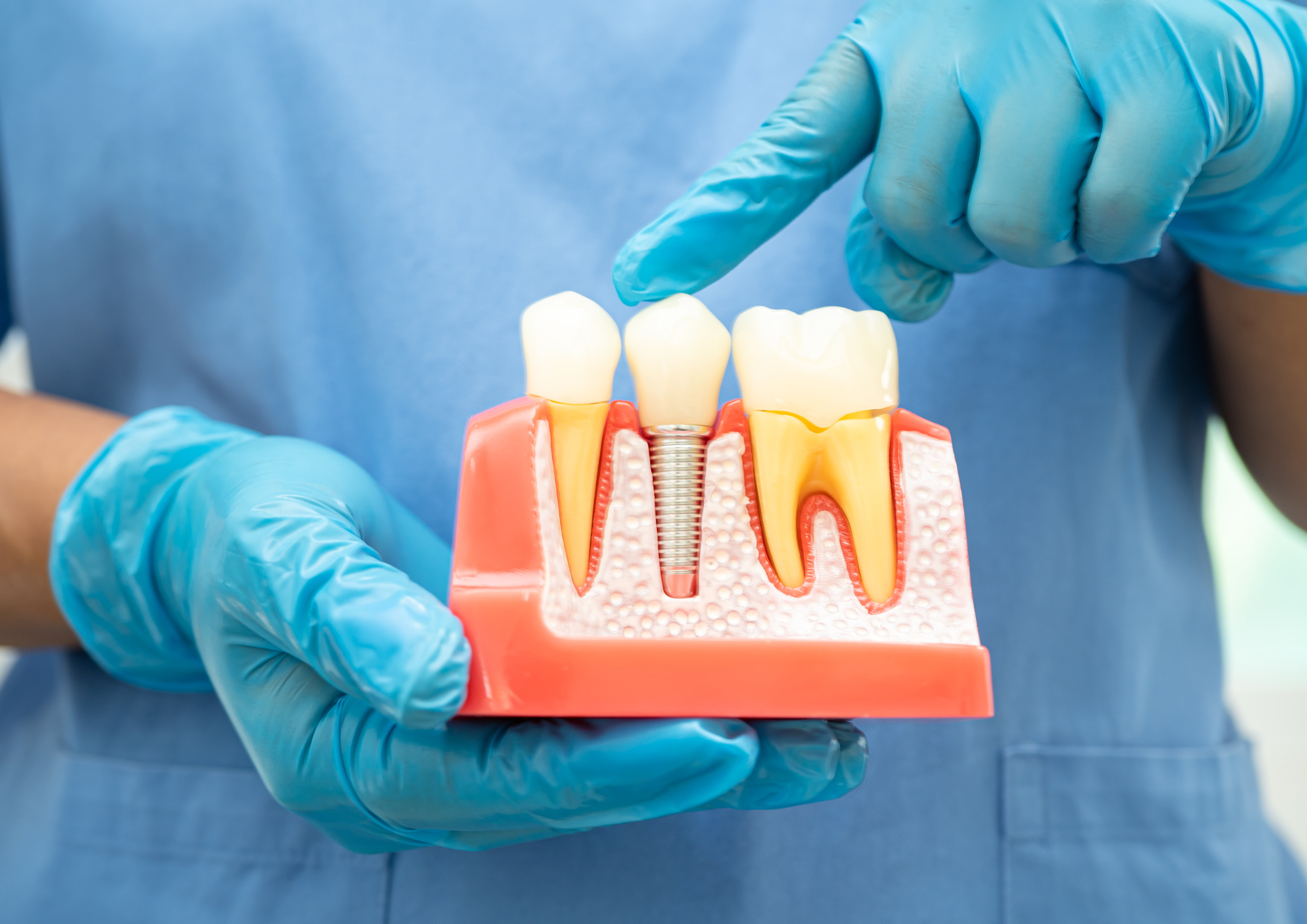 Implantes dentales San Sebastián de los Reyes , implante dental sanse.