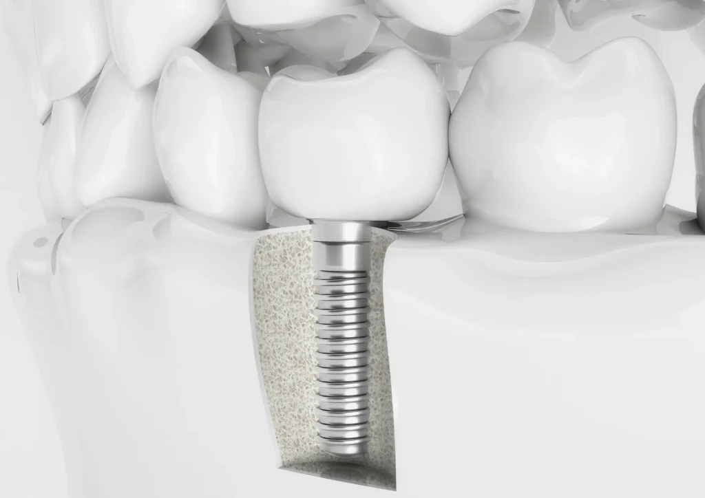 Garantía y precio final de un implante dental. Implante dental San Sebastian de los Reyes