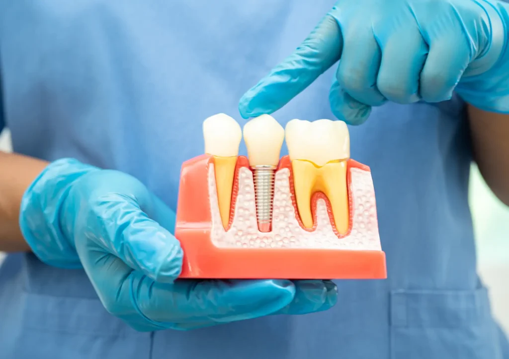 Implantes dentales San Sebastián de los Reyes , implante dental sanse.